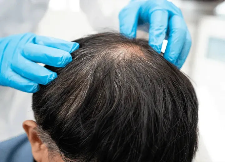 Avinora 3 in 1 Hair Growth Scalp Massager with gloved hands examining hair on a man's head