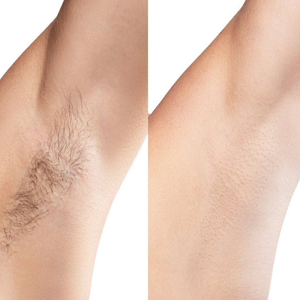 Comparison of hairy and shaved leg on a white background