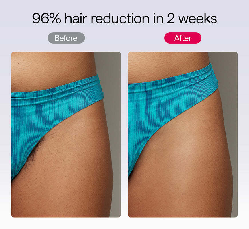 Before and after comparison of hair reduction on a person wearing blue underwear.