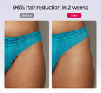 Before and after comparison of hair reduction on a person wearing blue underwear.