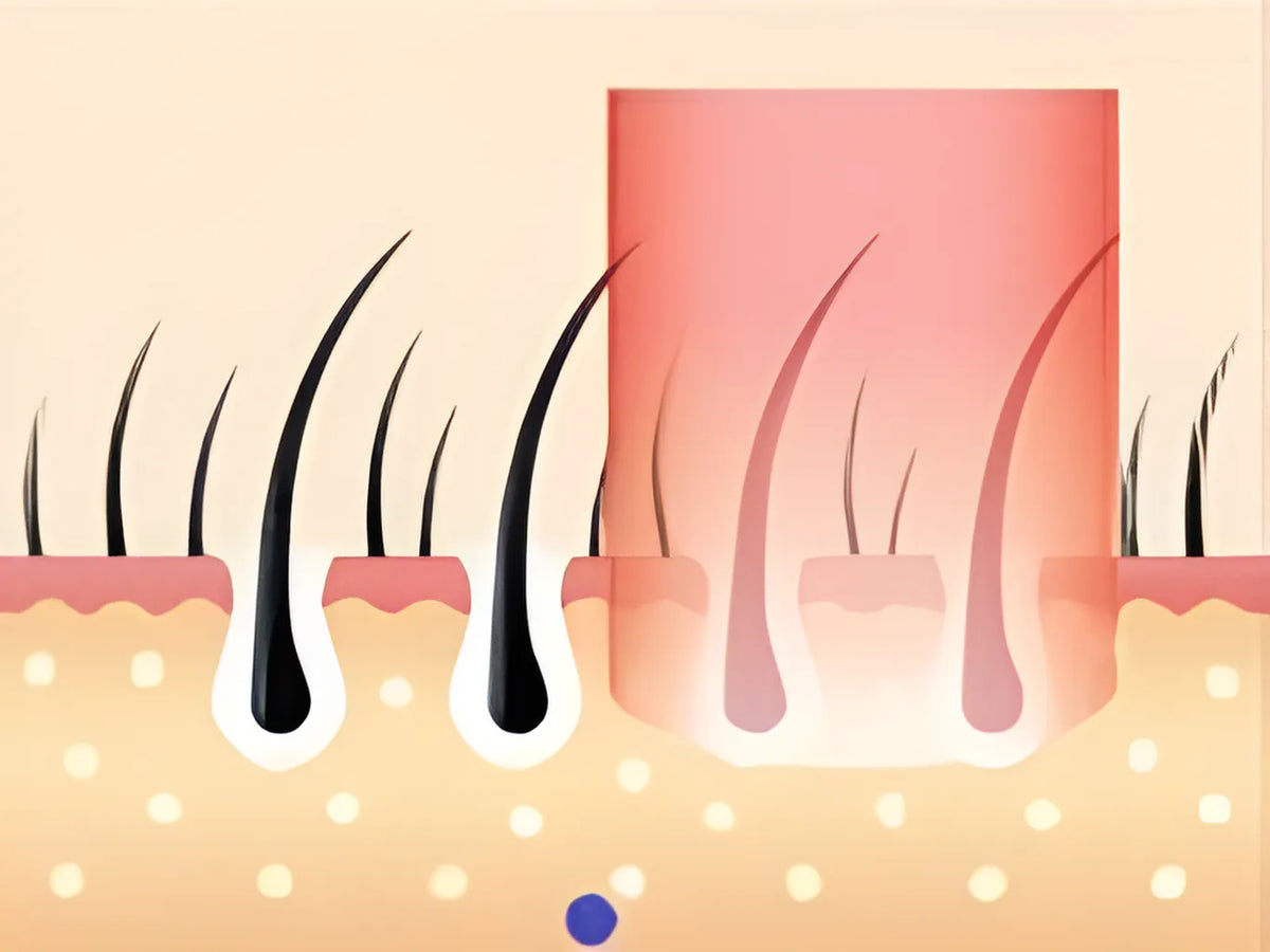 Noventrixa IPL Hair Removal AS20 treatment schedule for the first two weeks